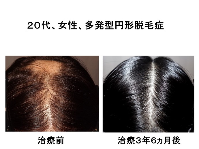 円形脱毛症　病院